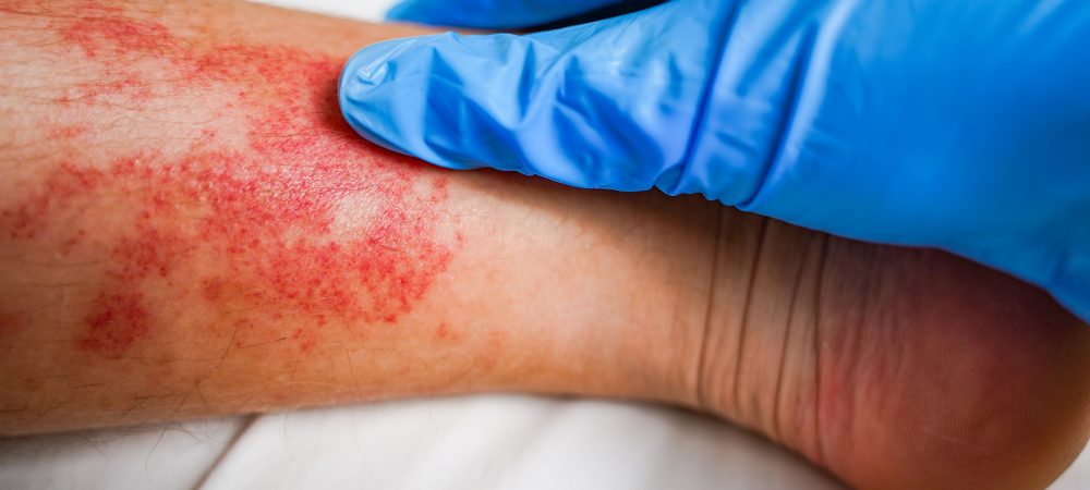 Disease of the skin on the legs, itchy red rashes and spots