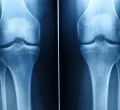 knee-x-ray